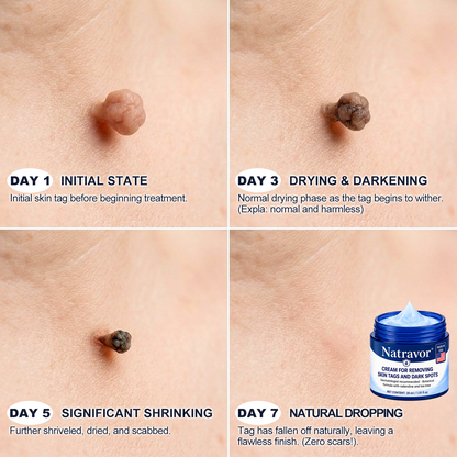 🔥 Last Day 50% OFF –Natravor® 7-𝐃𝐚𝐲 𝐒𝐤𝐢𝐧 𝐓𝐚𝐠 & 𝐒𝐩𝐨𝐭 𝐄𝐫𝐚𝐬𝐞𝐫 𝐂𝐫𝐞𝐚𝐦 (Zero Pain, Zero 𝐒𝐜𝐚𝐫𝐬 Formula) 💎