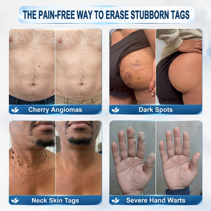 🔥 Last Day 50% OFF –Natravor® 7-𝐃𝐚𝐲 𝐒𝐤𝐢𝐧 𝐓𝐚𝐠 & 𝐒𝐩𝐨𝐭 𝐄𝐫𝐚𝐬𝐞𝐫 𝐂𝐫𝐞𝐚𝐦 (Zero Pain, Zero 𝐒𝐜𝐚𝐫𝐬 Formula) 💎